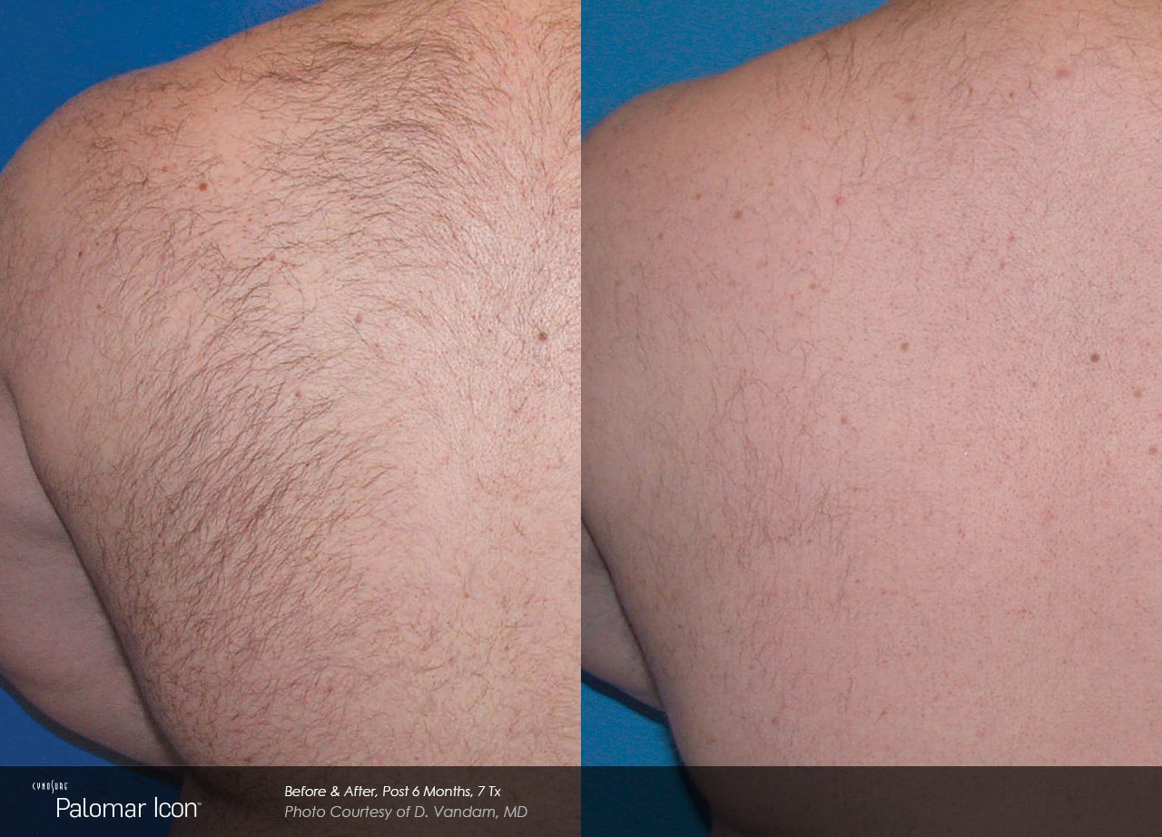 Laser Hair Removal | Graham Dermatology, image size:1280x922